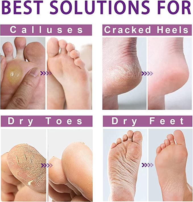 KIND REBEL Foot Peel Mask - Exfoliator Peel Off Calluses Dead Skin Callus Remover